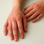 Exercise induced urticaria and exercise induced hives
